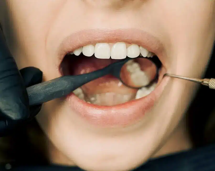 Fracturas Radiculares Dentales: Causas, Síntomas y Tratamientos