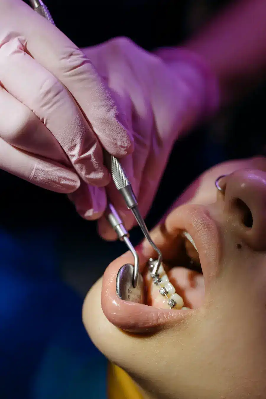 Prótesis sobre Implantes: Soluciones Efectivas para Restaurar tu Sonrisa